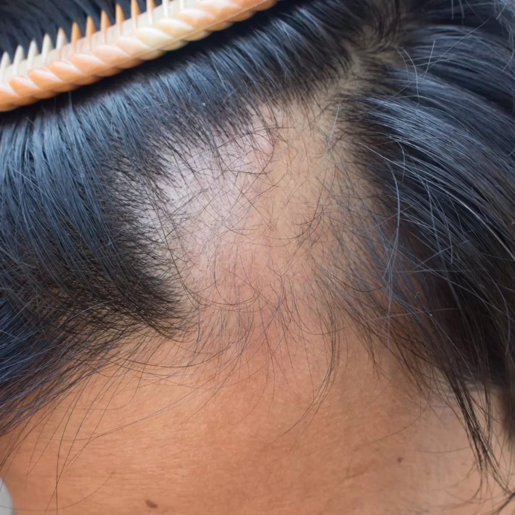 Terapia Capilar