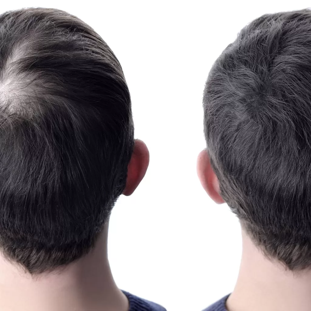 TerapiaCapilar-antes-depois